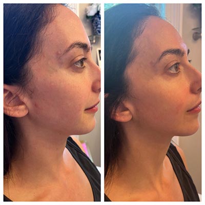Before and After Images at Salt Boutique Labs Med Spa in Wappingers Falls, NY