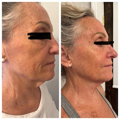 Before and After Images at Salt Boutique Labs Med Spa in Wappingers Falls, NY