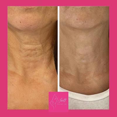 Before and After Images at Salt Boutique Labs Med Spa in Wappingers Falls, NY