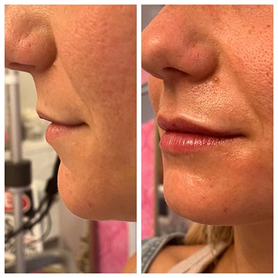 Before and After Images at Salt Boutique Labs Med Spa in Wappingers Falls, NY