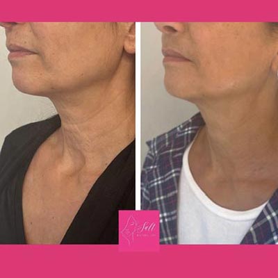 Before and After Images at Salt Boutique Labs Med Spa in Wappingers Falls, NY