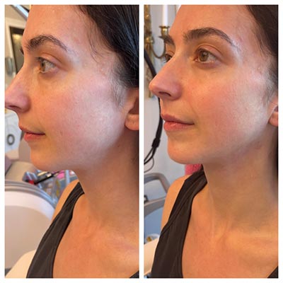 Before and After Images at Salt Boutique Labs Med Spa in Wappingers Falls, NY
