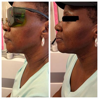 Before and After Images at Salt Boutique Labs Med Spa in Wappingers Falls, NY
