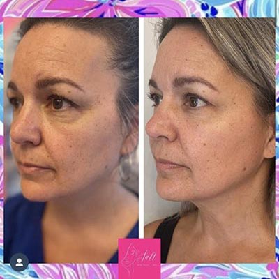 Before and After Images at Salt Boutique Labs Med Spa in Wappingers Falls, NY