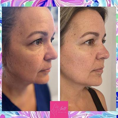 Before and After Images at Salt Boutique Labs Med Spa in Wappingers Falls, NY
