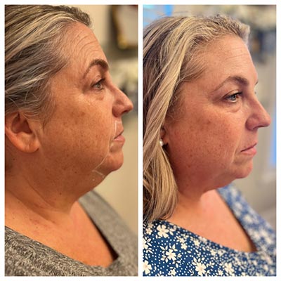 Before and After Images at Salt Boutique Labs Med Spa in Wappingers Falls, NY