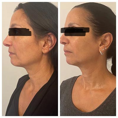 Before and After Images at Salt Boutique Labs Med Spa in Wappingers Falls, NY