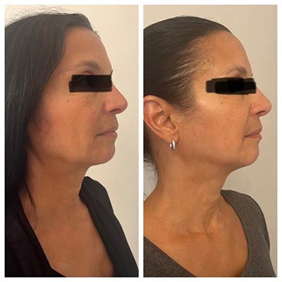 Before and After Images at Salt Boutique Labs Med Spa in Wappingers Falls, NY