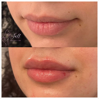 Before and After Images at Salt Boutique Labs Med Spa in Wappingers Falls, NY