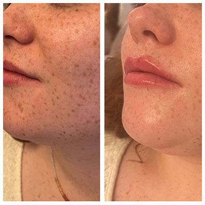 Before and After Images at Salt Boutique Labs Med Spa in Wappingers Falls, NY