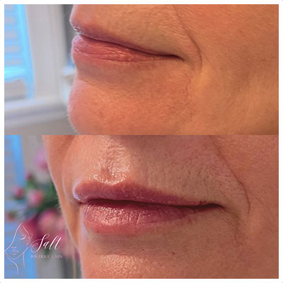 Before and After Images at Salt Boutique Labs Med Spa in Wappingers Falls, NY