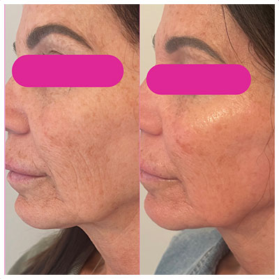 Before and After Images at Salt Boutique Labs Med Spa in Wappingers Falls, NY