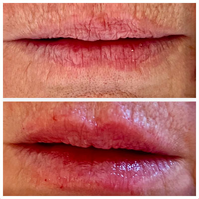 Before and After Images at Salt Boutique Labs Med Spa in Wappingers Falls, NY