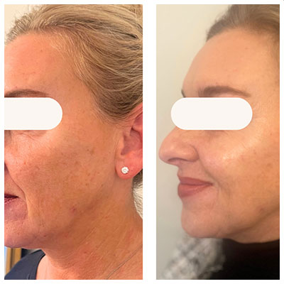 Before and After Images at Salt Boutique Labs Med Spa in Wappingers Falls, NY