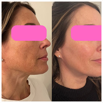 Before and After Images at Salt Boutique Labs Med Spa in Wappingers Falls, NY