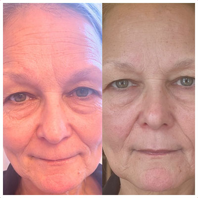 Before and After Images at Salt Boutique Labs Med Spa in Wappingers Falls, NY