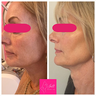 Before and After Images at Salt Boutique Labs Med Spa in Wappingers Falls, NY