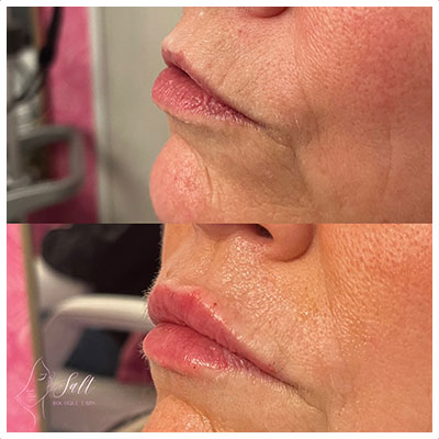 Before and After Images at Salt Boutique Labs Med Spa in Wappingers Falls, NY